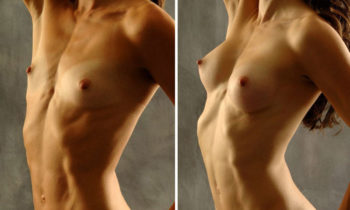 Breast Lift Vs. Breast Augmentation