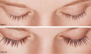 What Is LATISSE?