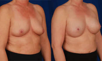 Best Age For A Breast Augmentation?