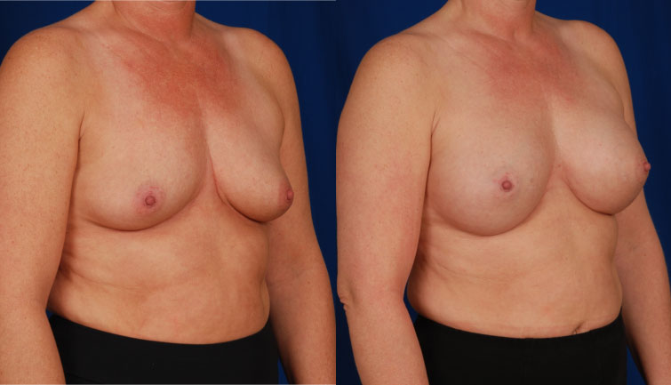denver cosmetic breast surgery
