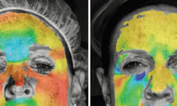 Heat Maps Show How Effective Botox is with 3D Imaging Technique