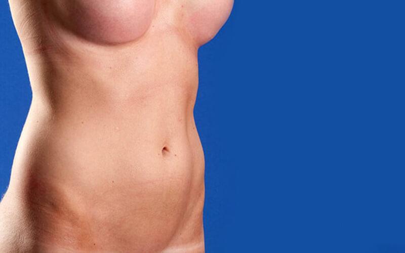 liposuction in denver