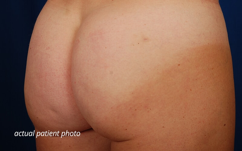 fat transfer buttock augmentation
