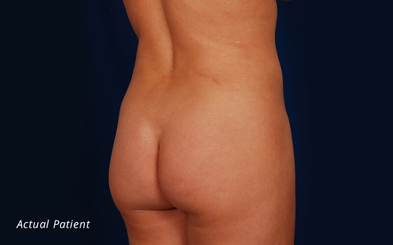 Is Butt Augmentation in Denver Right For You? - Plastic Surgery in Denver,  Colorado