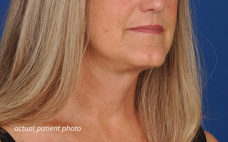 facelift surgery after