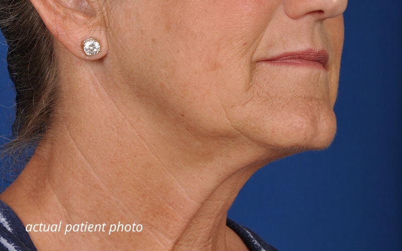 facelift surgery before 