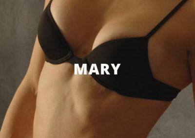 Mary Breast Augmentation Pictures