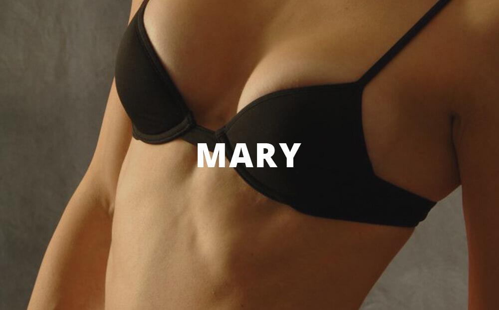 Mary Breast Augmentation Pictures