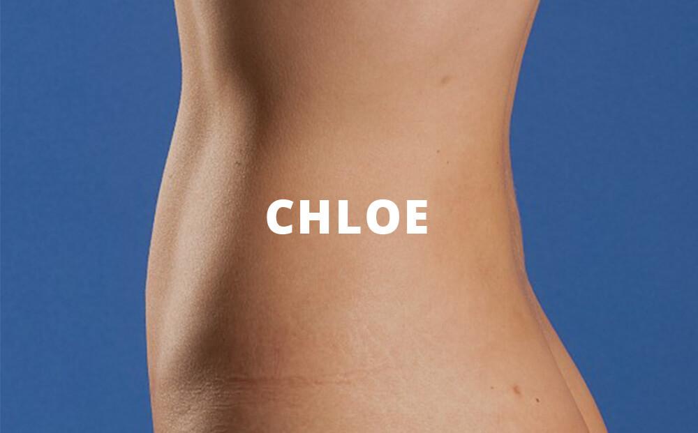Chloe Vaser High Definition Liposuction Before and After