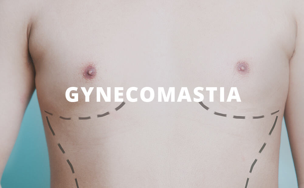 Gynecomastia in Denver