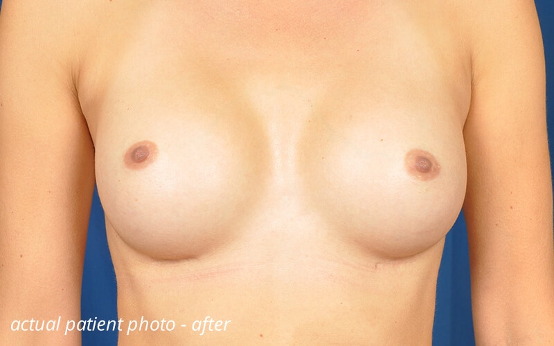 inverted nipples after surgery