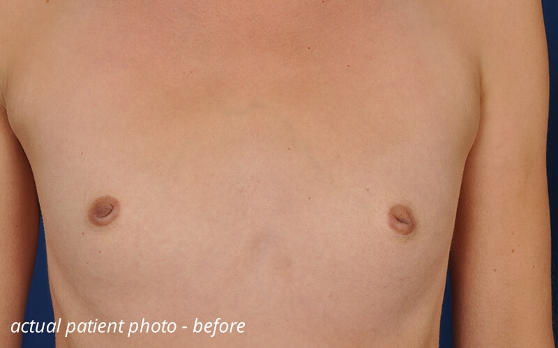 inverted nipples before surgery