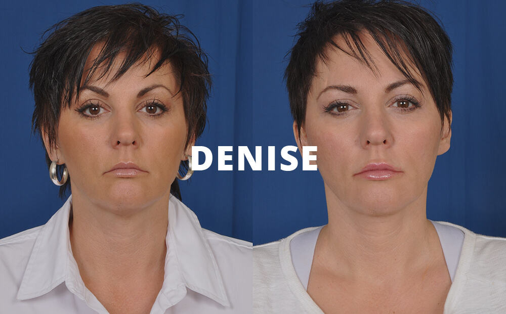 Denise Before and After Facelift Surgery