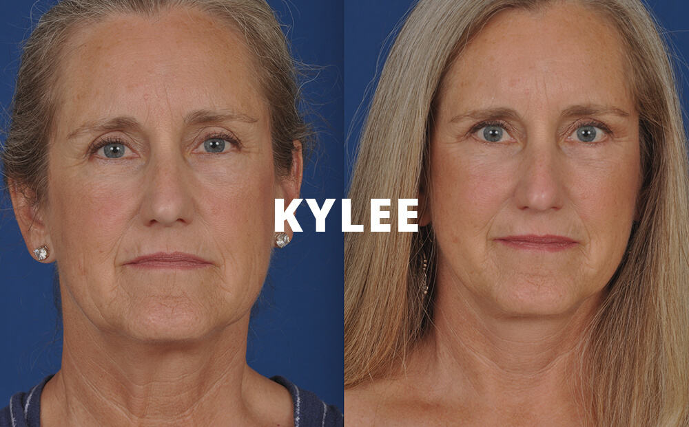 Kylee Before and After Facelift Surgery
