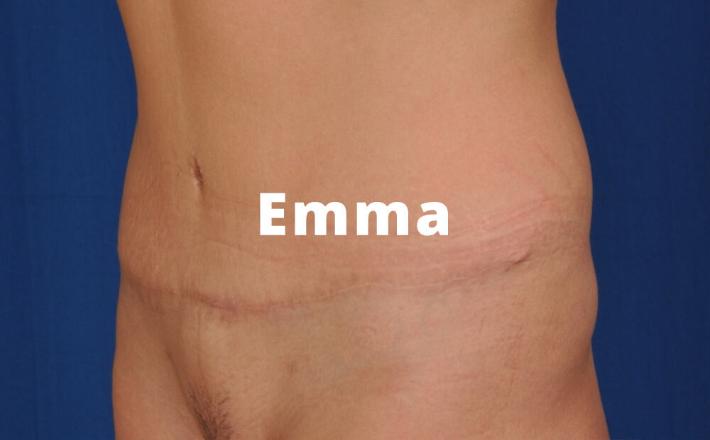 tummy tuck before and after pics 