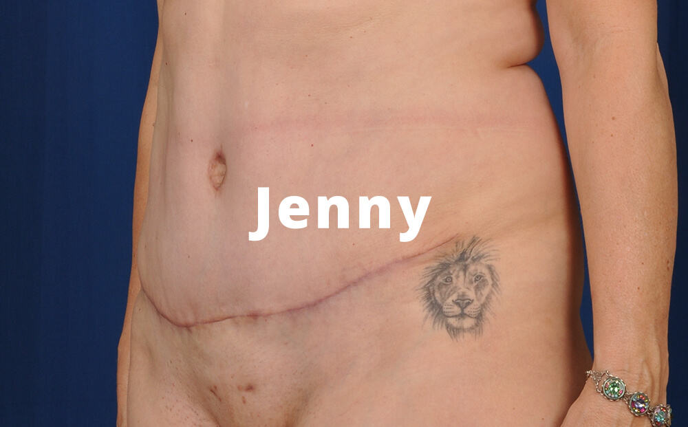 Tummy Tuck Before and After images