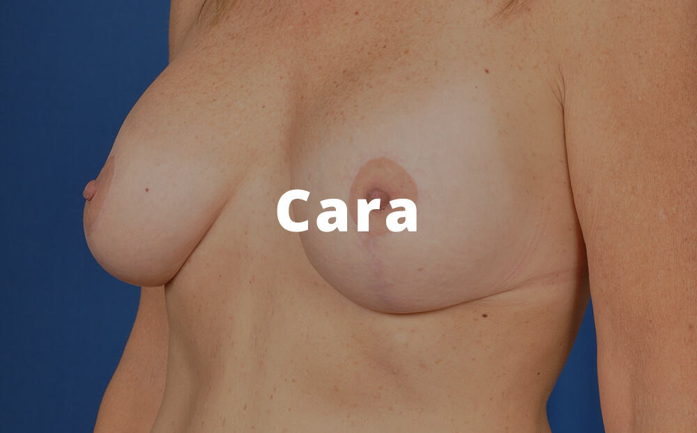 Cara Breast Augmentation Surgery