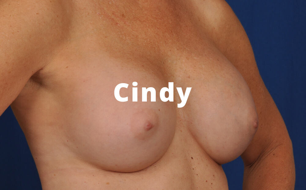 Cindy Breast Augmentation Before and After