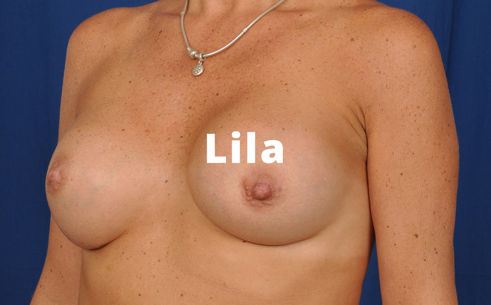 Lila Breast Augmentation Gallery