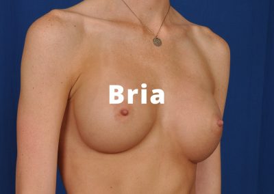 Bria Breast Aug Results