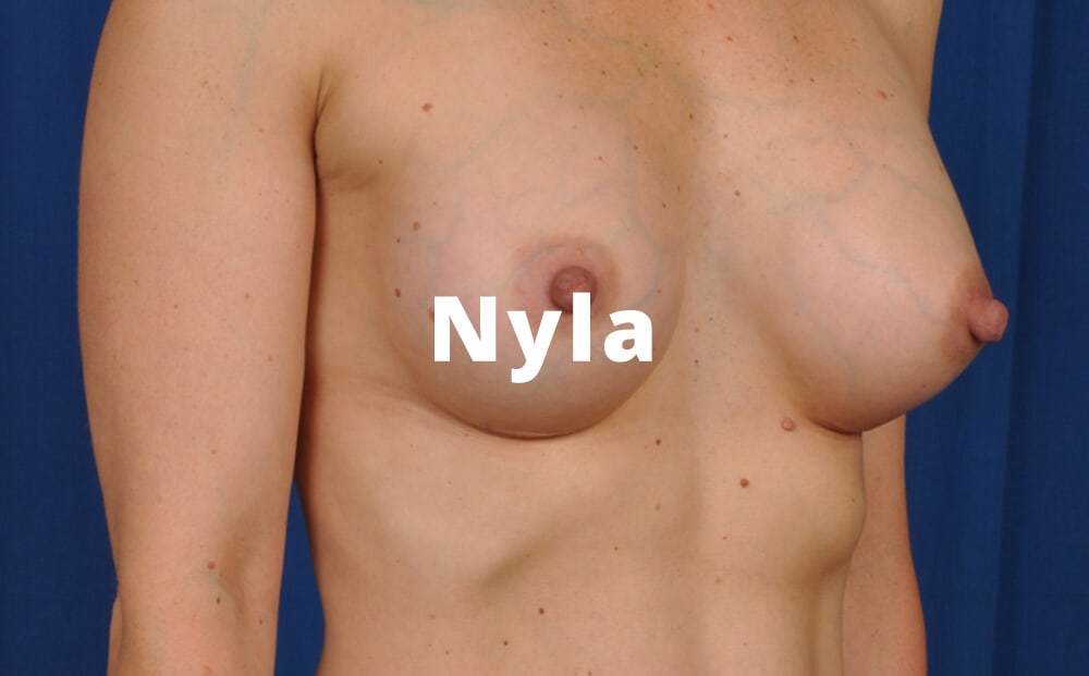 Nyla Breast Aug Gallery