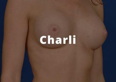 Charli Breast Augmentation Results