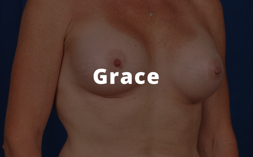 Grace Breast Augmentation Surgery