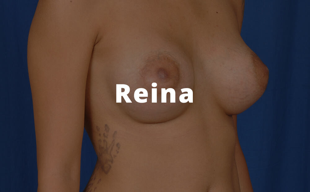 Reina Breast Augmentation Before and After Images