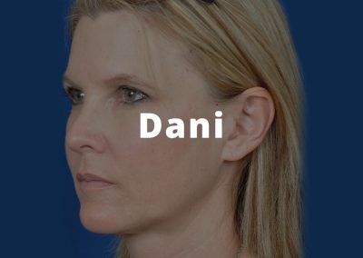 Dani Eyelid Lift Surgery