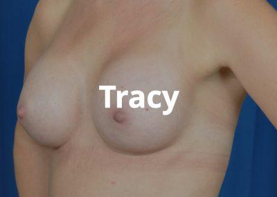 Tracy Breast Augmentation Before and After Gallery