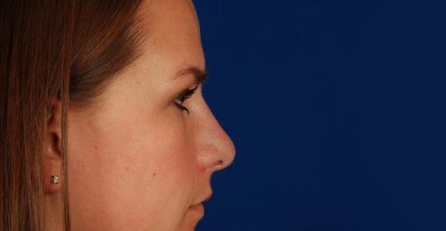 Miranda after rhinoplasty surgery