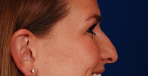 Miranda before open septorhinoplasty surgery