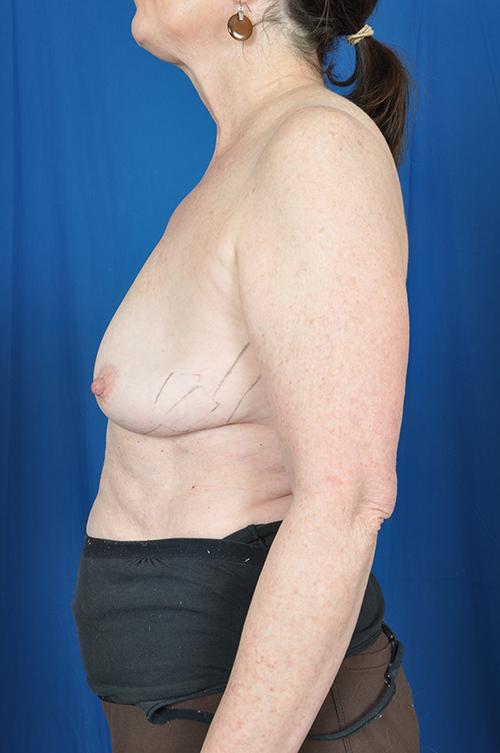 Sharon breast implant removal after 1