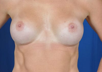 teardrop breast implants results