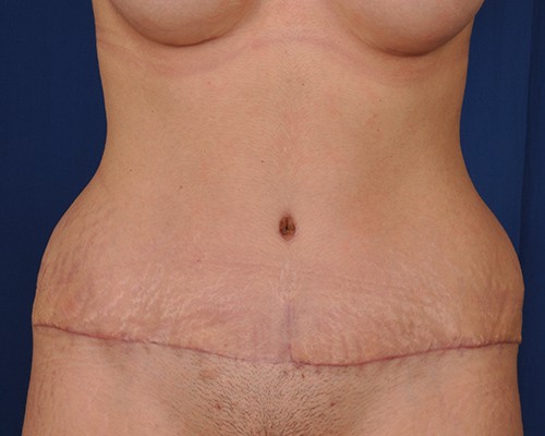 Naomi After Tummy tuck (Abdominoplasty) with low transverse incision