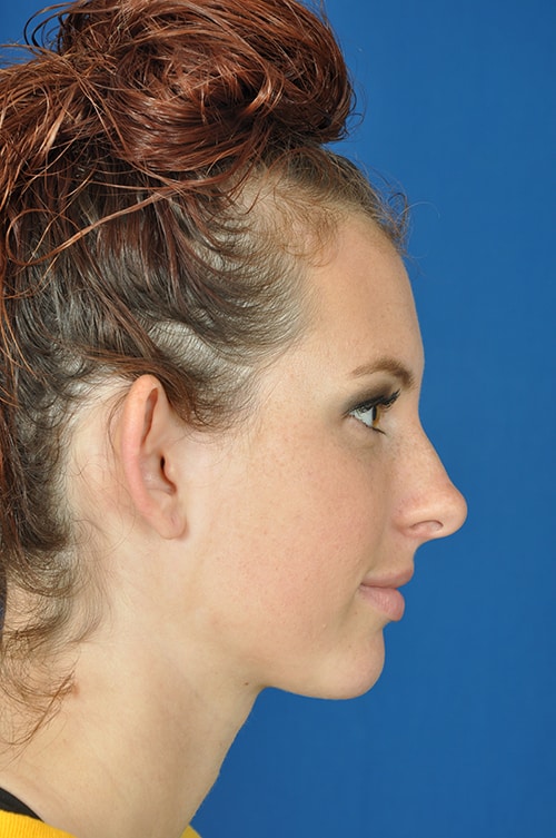 brianna before otoplasty (ear pinning) 