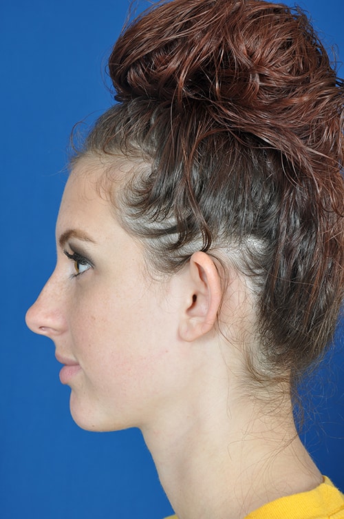 Brianna before otoplasty (ear pinning) surgery