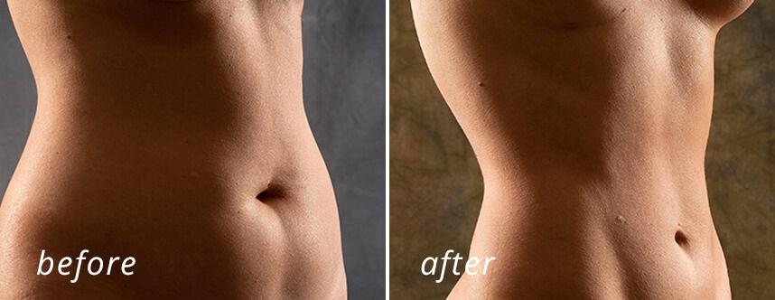 Lipo before after 2