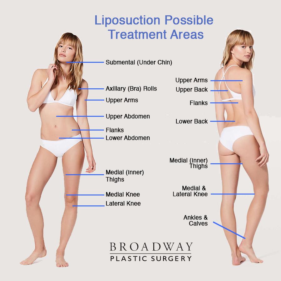 Liposuction Possible Treatment Areas
