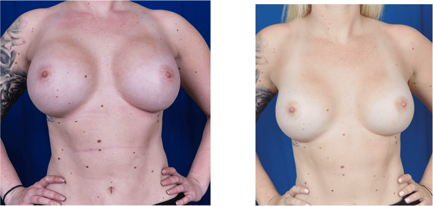 28-year-old - before: 550 cc silicone gel implants - after: 385 cc moderate plus smooth round Sientra silicone gel implants. Breast implant replacement surgery