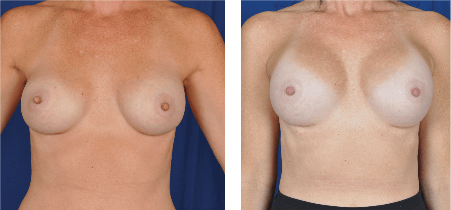 41-year-old - before: Allergan 425 cc macro-textured high-profile silicone gel breast implant - after: 470 cc Sientra smooth round implants. Breast implant replacement surgery