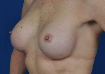 breast implant exchange