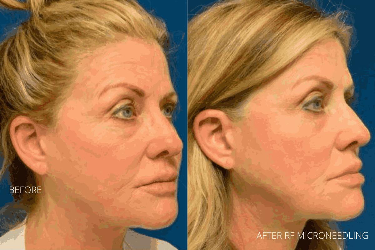 2 rf microneedling