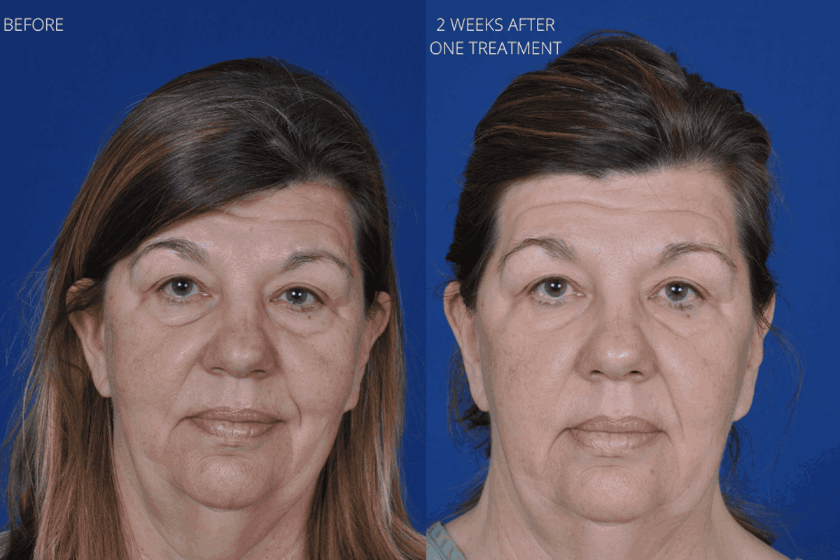 blepharoplasty agnes scarlet 1