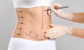 Tummy Tuck Recovery: What to Expect