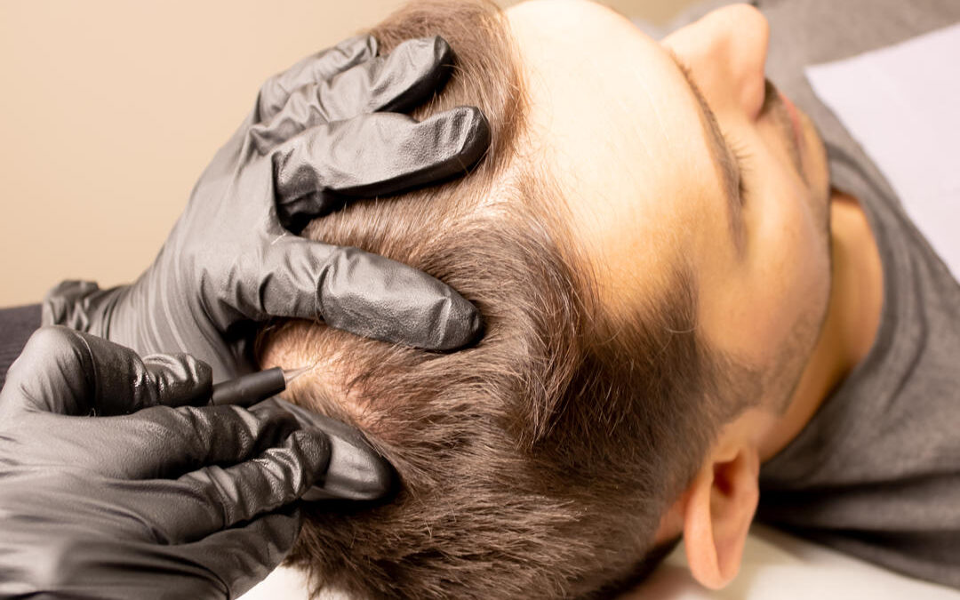 Revolutionizing Hair Restoration with Stem Cells