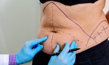 Tummy Tuck Recovery: Tips and Timelines