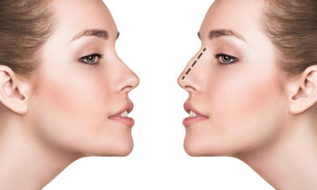 RhinoplastyThumbnail