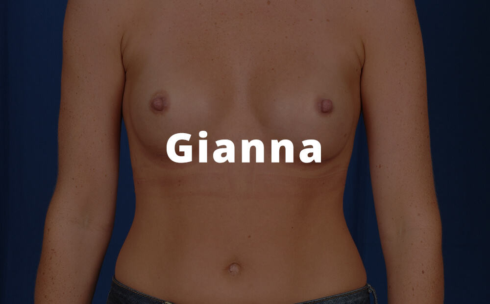 Gianna Breast Aug Pics