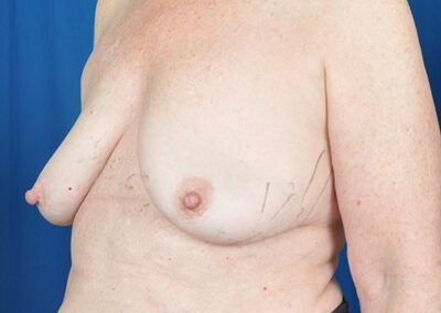 sharon breast implant removal